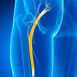 Tecar per lombosciatalgia