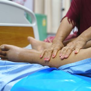 Linfedema alle gambe