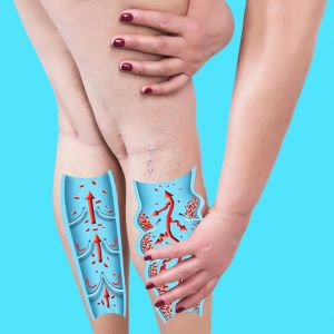 Linfedema gambe sintomi e rimedi efficaci