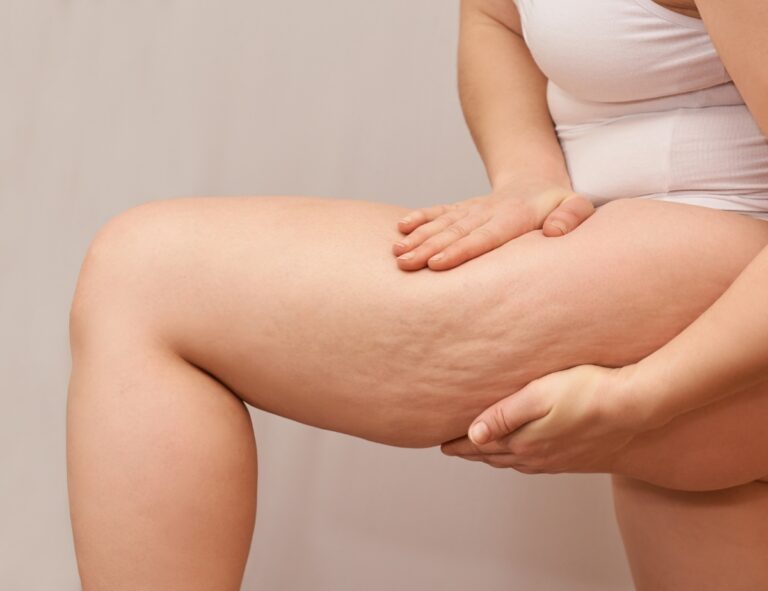 rimedi per la cellulite sulle gambe