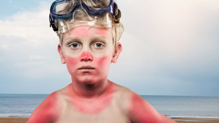 Oli essenziali per scottature solari