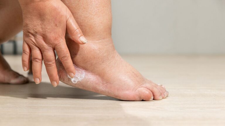 Edema alle gambe