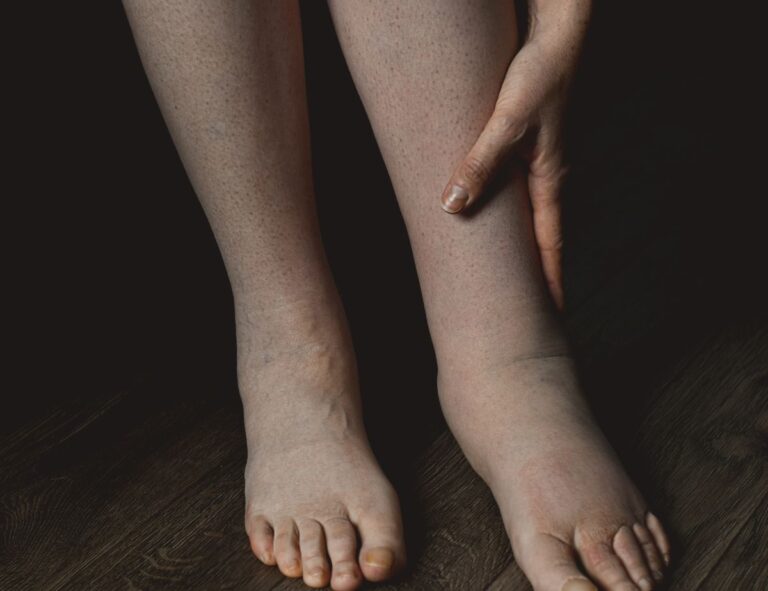 liquido nelle gambe