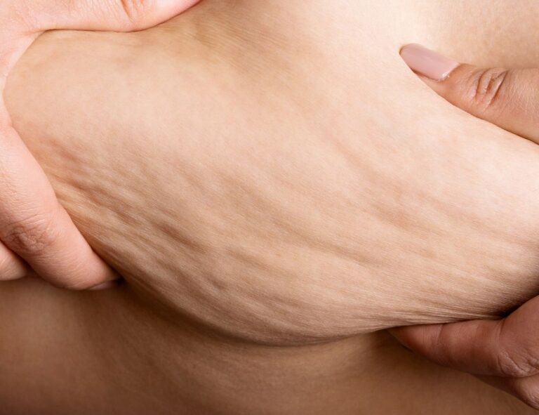 cellulite maschile