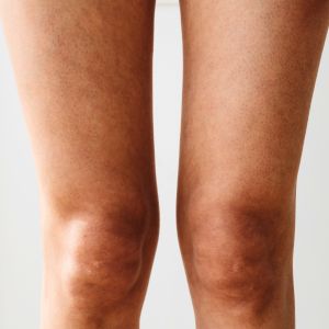 Dolori lombari e alle gambe