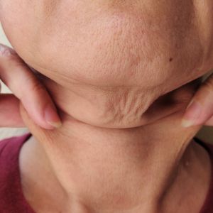 Rughe nel collo come trattarle in modo efficace