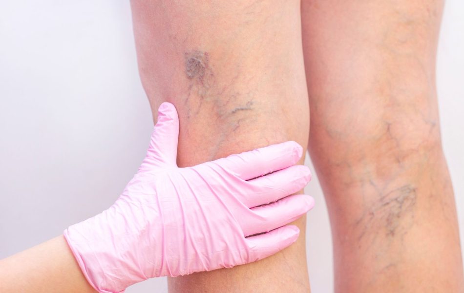 Gambe pesanti, vene evidenti e gonfiore