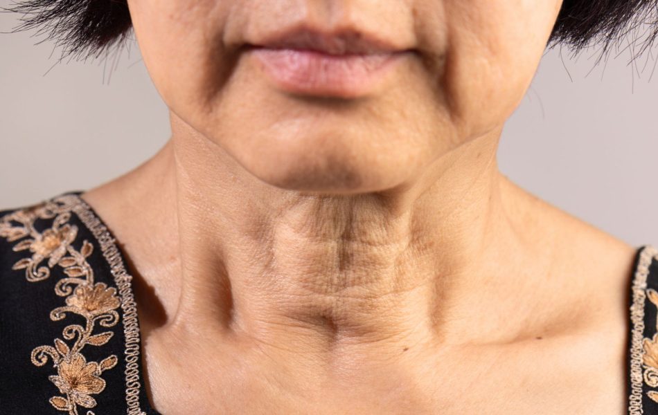 Rughe nel collo come trattarle in modo efficace