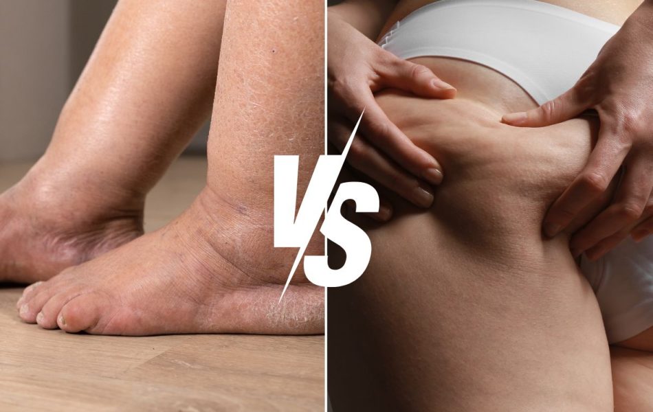 differenze tra cellulite e ritenzione idrica